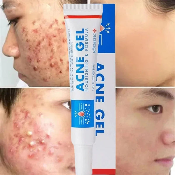 Effective Acne Removal Cream Anti-Acne Repair Redness Pimple Spots Gel Deep Cleaning Pore Oil Control Moisturizing Skin Care 30g Buyfinity
