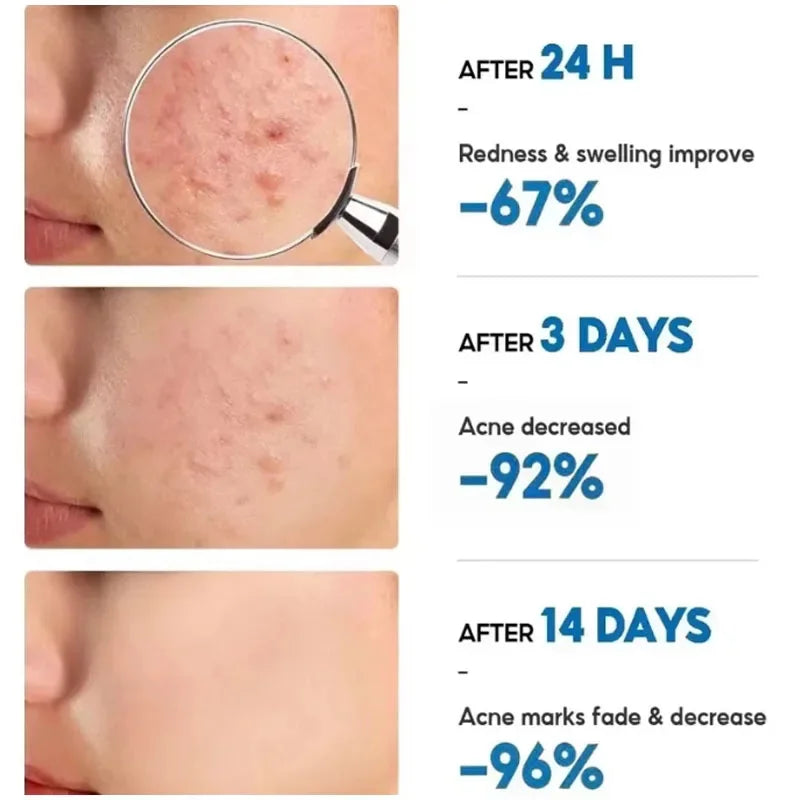 Effective Acne Removal Cream Anti-Acne Repair Redness Pimple Spots Gel Deep Cleaning Pore Oil Control Moisturizing Skin Care 30g Buyfinity