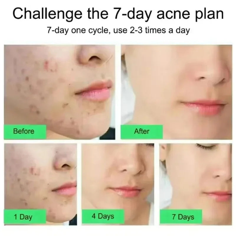 Effective Acne Removal Cream Anti-Acne Repair Redness Pimple Spots Gel Deep Cleaning Pore Oil Control Moisturizing Skin Care 30g Buyfinity