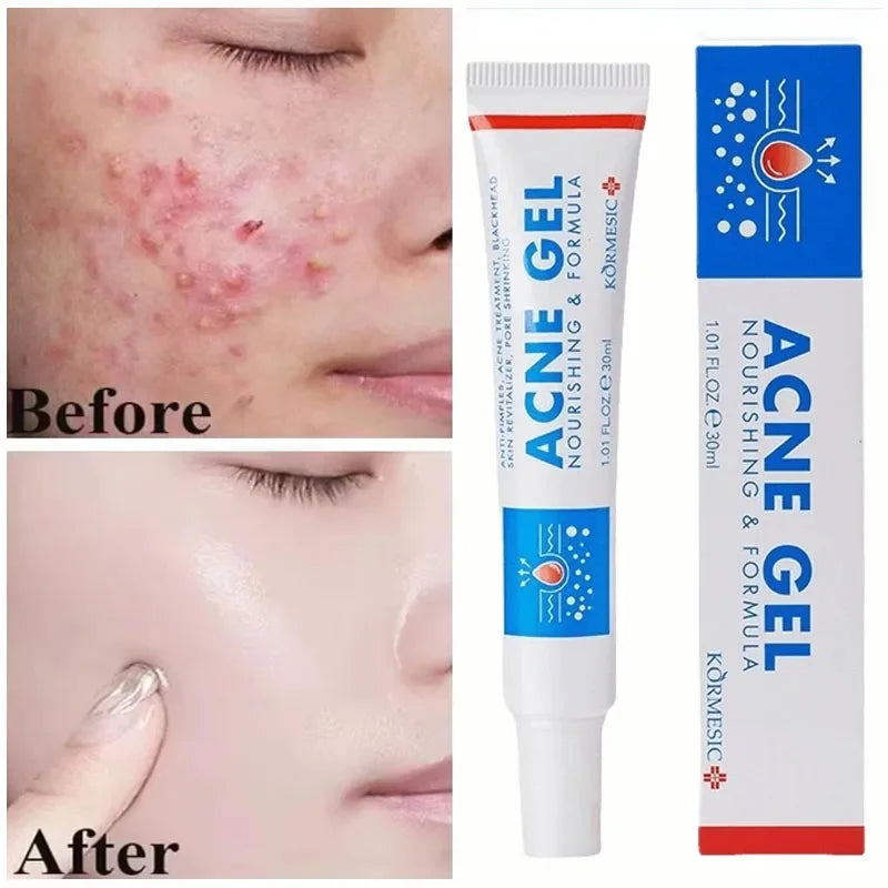 Effective Acne Removal Cream Anti-Acne Repair Redness Pimple Spots Gel Deep Cleaning Pore Oil Control Moisturizing Skin Care 30g Buyfinity