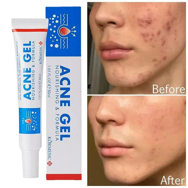 Effective Acne Removal Cream Anti-Acne Repair Redness Pimple Spots Gel Deep Cleaning Pore Oil Control Moisturizing Skin Care 30g Buyfinity